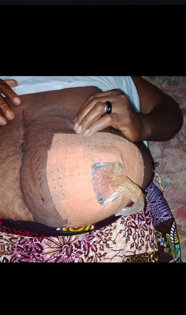 Aidons à financer le traitement contre le cancer du sein