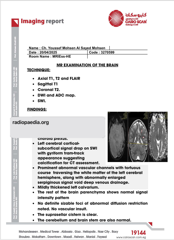 Help save a child with Sturge-weber syndrome