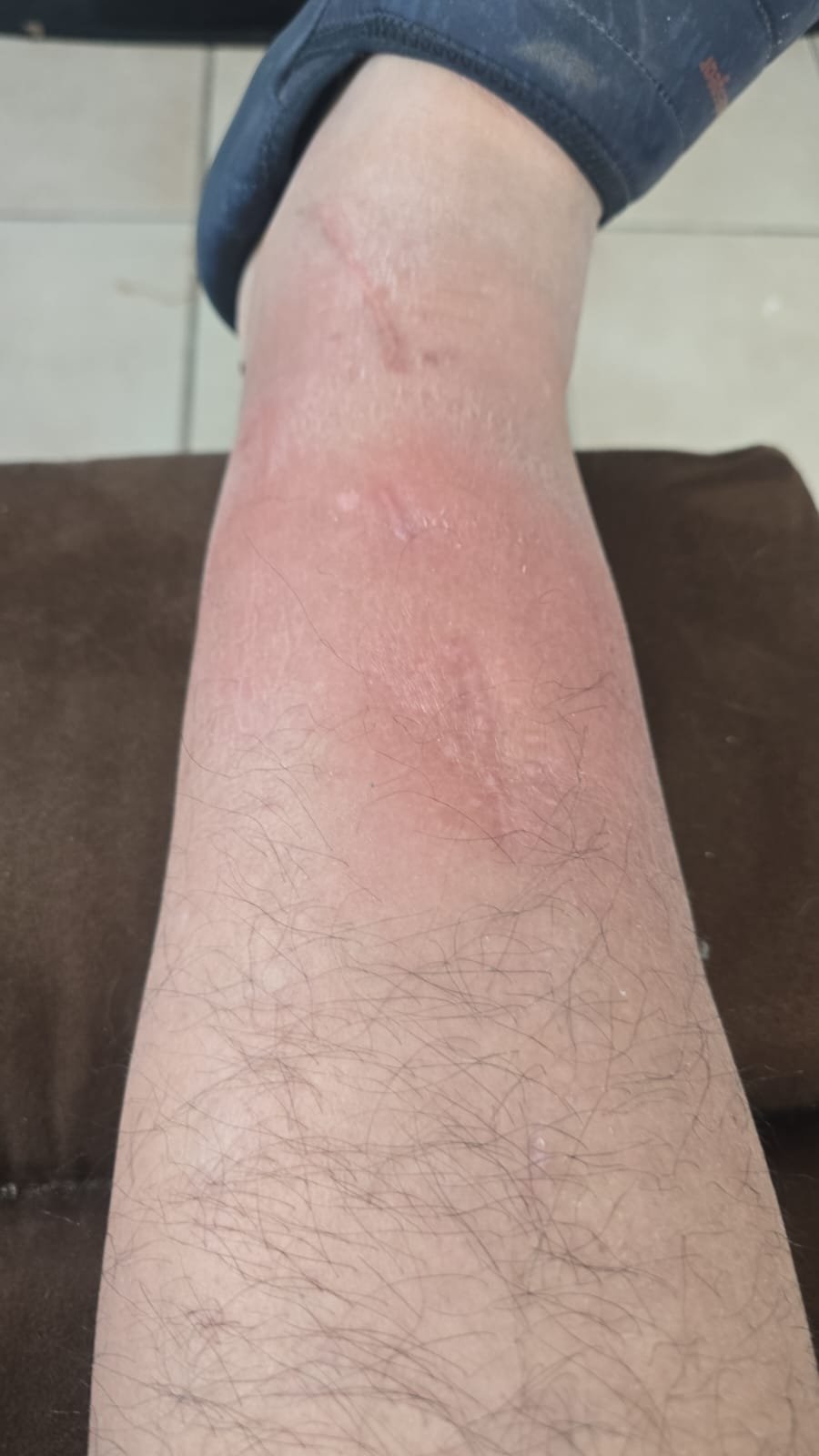 Help with my dad's surgery to save his leg