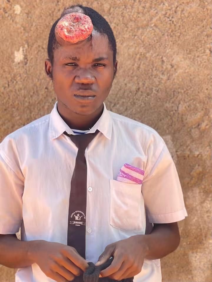 Urgent Medical Appeal: Help 19-Year-Old Chaure Undergo Life-Saving Head Tumor Surgery