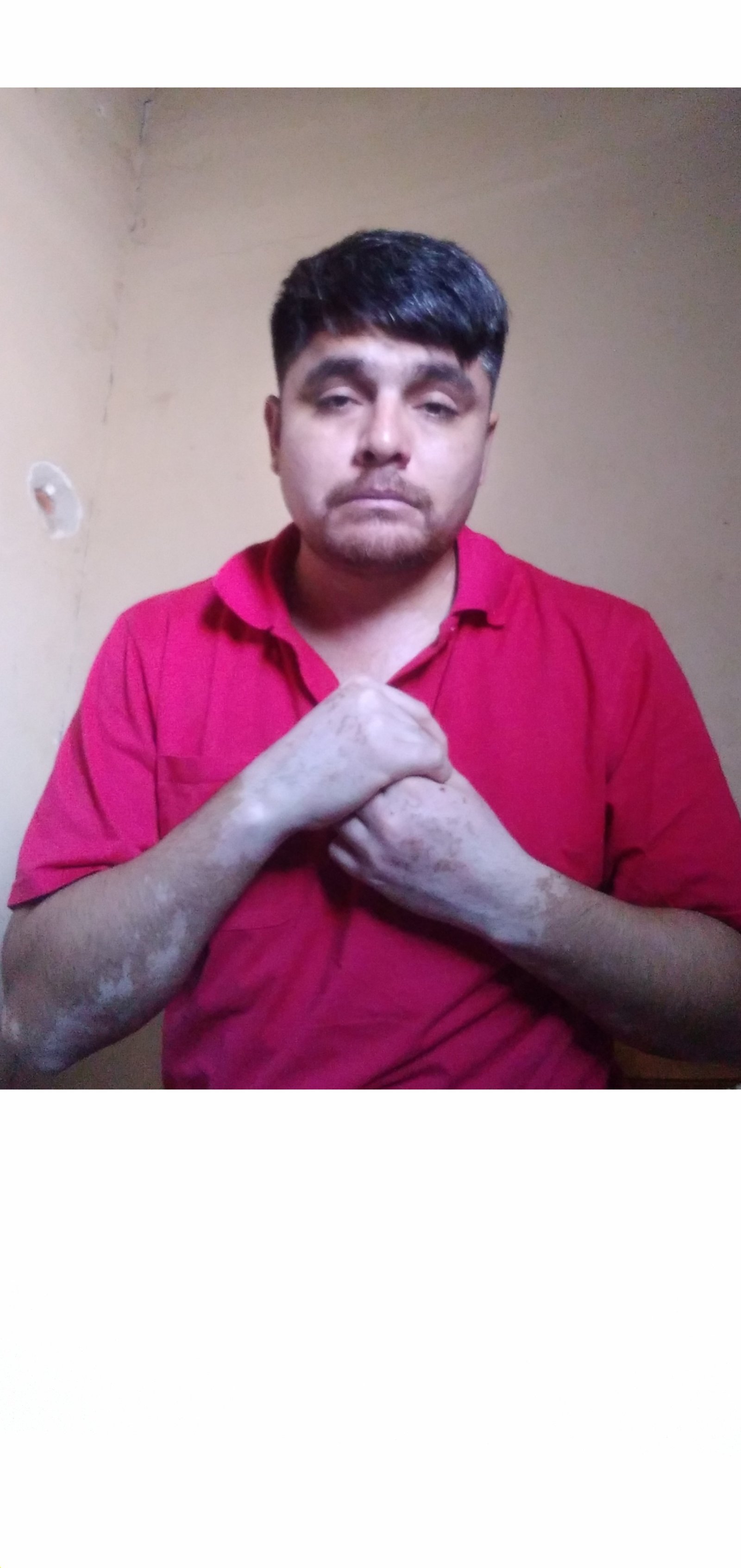 Ayudalo asi  pueda tratar  su vitiligo