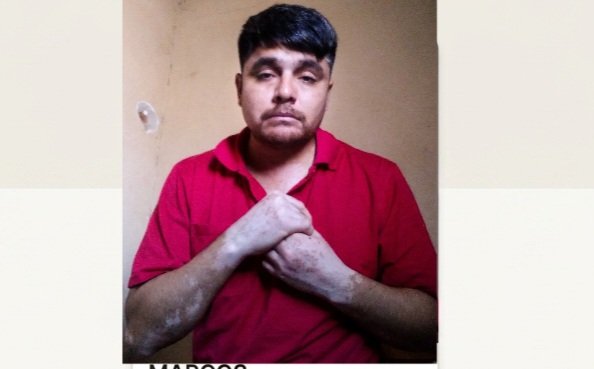 Ayudalo asi  pueda tratar  su vitiligo