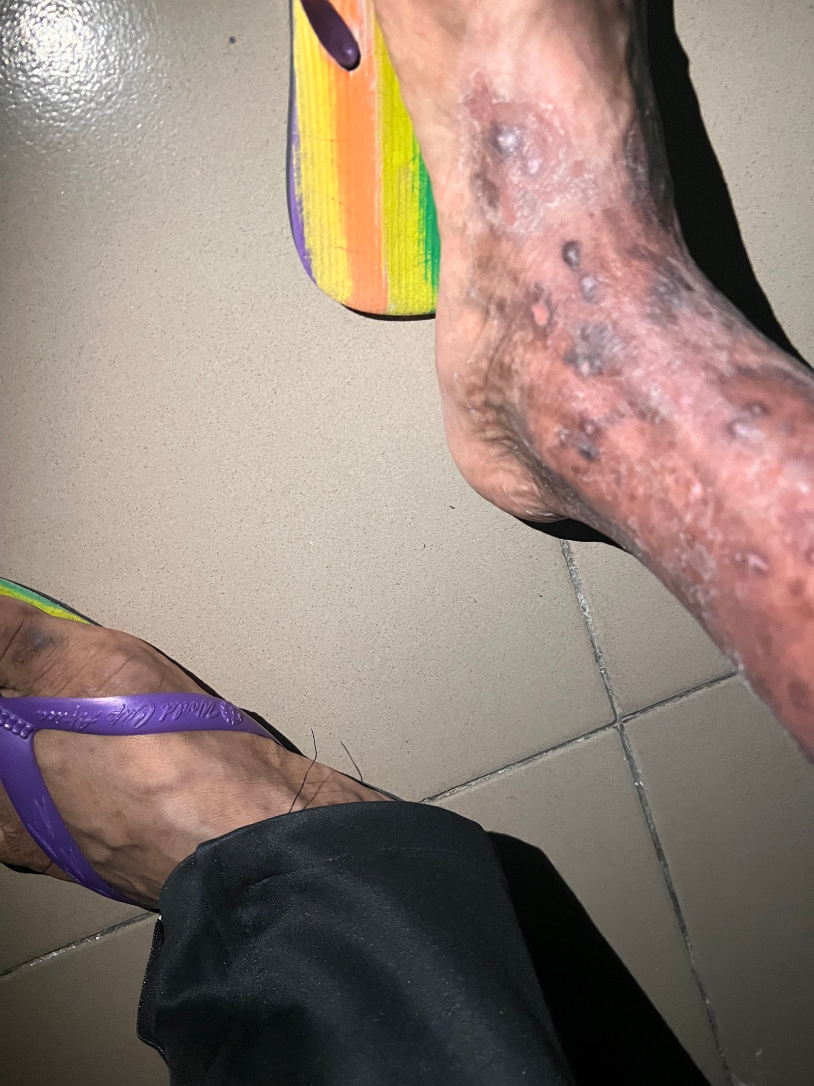 Help Marvellous Mbonu Overcome Severe Staph Infection in Nigeria